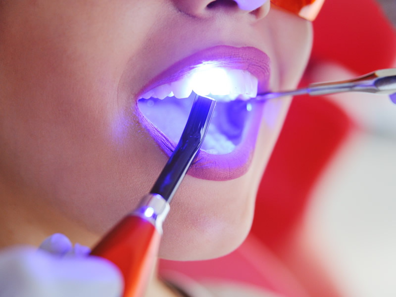 White / Tooth coloured fillings with composite bonding