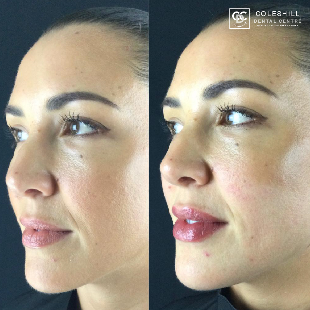 Coleshill Facial Aesthetics Botox Lip Filler Birmingham