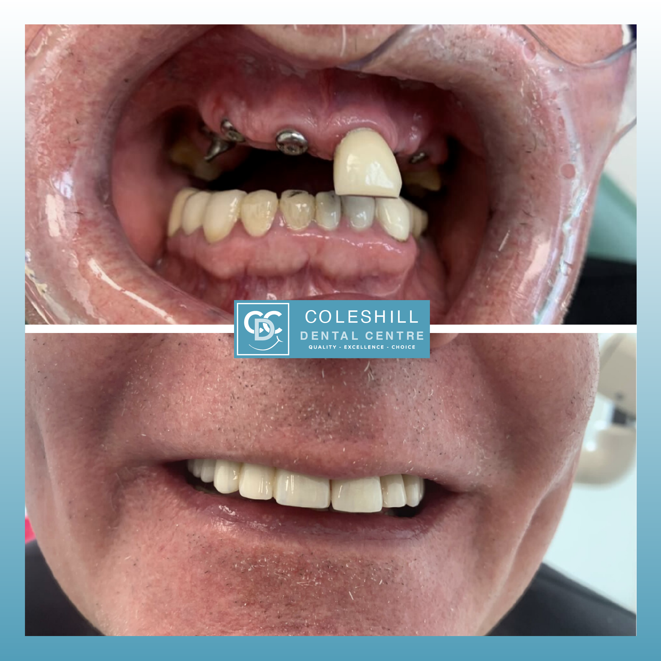 Coleshill Dental Centre Missing Teeth Birmingham Dental Implants Warwickshire