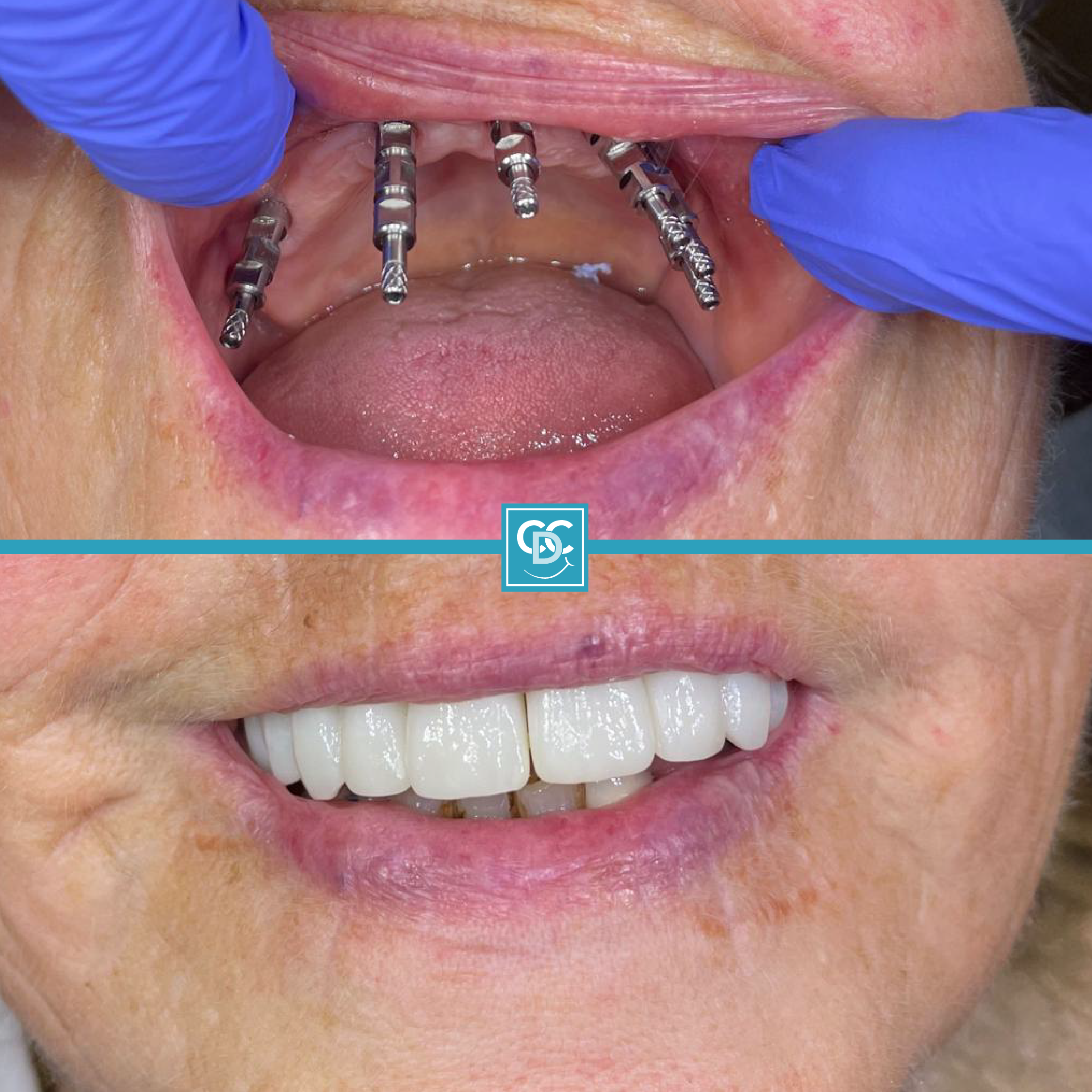 Coleshill Dental Centre Missing Teeth Birmingham Dental Implants