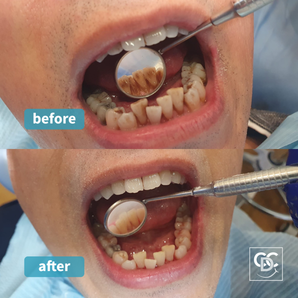 Coleshill Dental Airflow Polish Stain Removal Birmingham