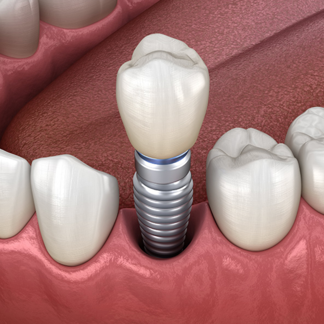 Coleshill Dental Centre Missing Teeth Birmingham Dental Implants Warwickshire