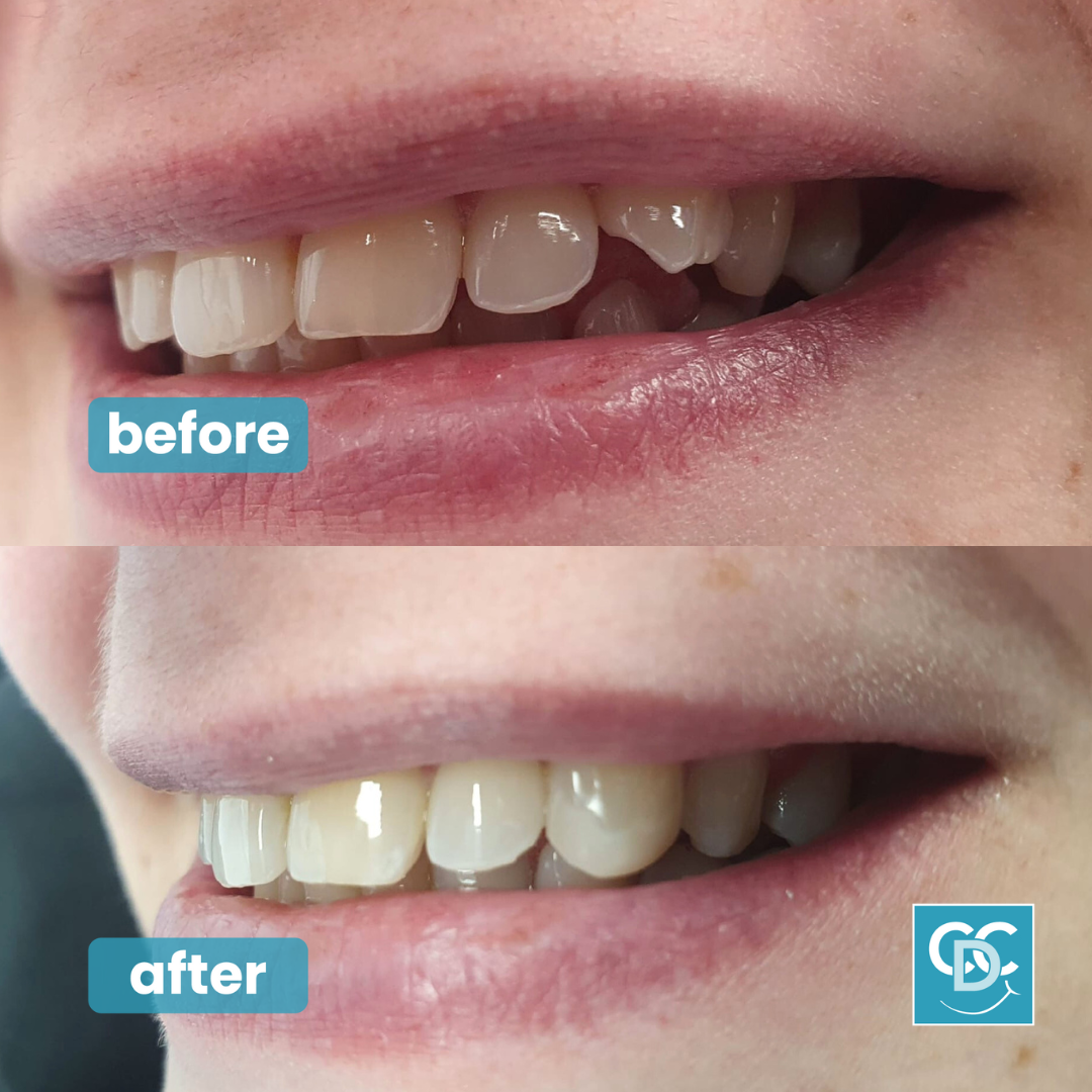 Composite Bonding Birmingham Coleshill Tamworth Smile Makeover